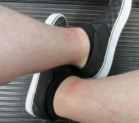 My Disney Rash on both legs